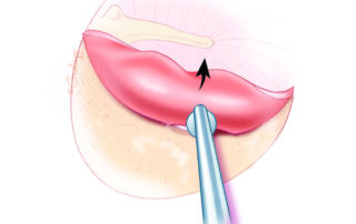 To avoid potential disturbance to the ossicles, the middle ear is first entered inferiorly. The stapes knife lifts the tympanic annulus out of its bony groove. With gentle downward and inward pressure, the knife can then safely fall over the margin into the posterior tympanic space.