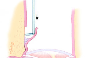 A bony prominence is often encountered slightly lateral to the tympanic membrane level.