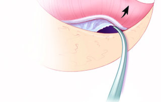 The tympanic mucosa is lysed with a curved needle. When done under local, lidocaine is infused into the middle ear to anesthetize the tympanic mucosa. To avoid anesthetizing the labyrinth with resultant postoperative vertigo, lidocaine should be promptly suctioned from the middle ear, especially from the round window niche where it tends to accumulate.