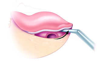 Elevation of the tympanic annulus inferiorly using an annulus elevator. To avoid tearing, it is important to maintain firm pressure against the bone. Elevation is with the side of the shaft, not the tip of the instrument. When under local, this maneuver is often incompletely anesthetized.
