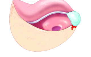 Bleeding from the inferior edge is common after this maneuver. Application of a small cube of epinephrine-soaked absorbable gelatin sponge readily controls.