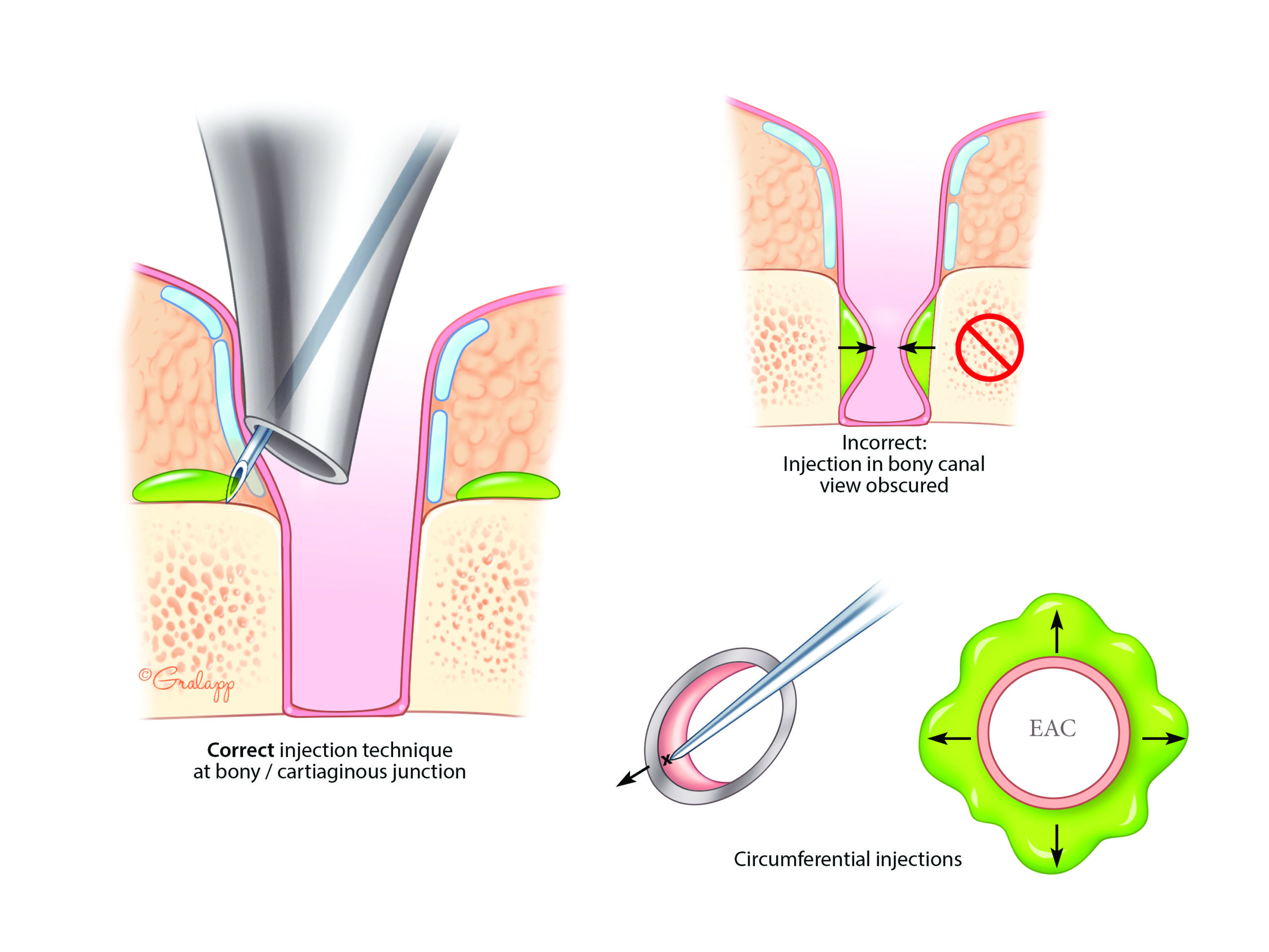 Middle Ear & Mastoid – Oto Surgery Atlas