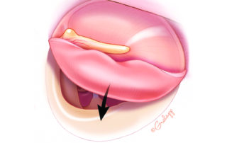 When the flap sags and limits the tympanotomy exposure, sometimes a blood clot may have formed under the flap. Its evacuation restores adequate exposure.