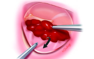 When the flap sags and limits the tympanotomy exposure, sometimes a blood clot may have formed under the flap. Its evacuation restores adequate exposure.