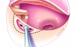 Most commonly the scutum (posterior ear canal overhang) allows at least a partial view of the stapes superstructure. It must be removed to provide full access to the oval window. Scutum removal may be done with either a curette or microdrill or a combination of the two.