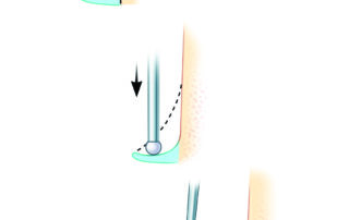 Combined technique in which the scutum is first thinned with a drill (e.g., 2.3-mm diamond) and then a curette removes the last shell. A diamond burr is slightly slower compared to a cutting burr, but is less likely to injure the chorda tympani, flap, or tympanic membrane.