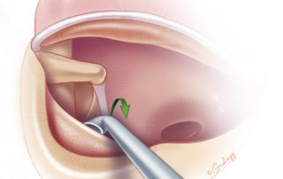 Use of a stapes curette to remove the scutum. The curette is firmly braced against the speculum to create a fulcrum effect. The motion is rotational and outward, never inward. A sudden release of inwardly directed force could lead to incus dislocation. Effective use of the curette takes practice and may be challenging for the novice. Considerable force is needed to fracture pieces of bone. When chipping away bone, it is important to prevent the curette from lurching outward where it can tear the canal skin and trigger bleeding.