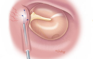 Injection of lidocaine with epinephrine via a 27-gauge needle in the posterior-superior ear canal resulting in vasoconstriction of the “vascular strip.”