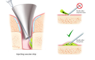 During vascular strip injection, the bevel of the needle must face the bone.