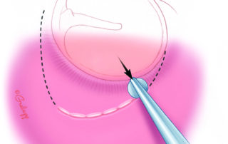 The incision line is first crushed with a round stapes knife. This maneuver squeezes closed blood vessels and thereby reduces bleeding. It also helps minimize flap tearing during incision.