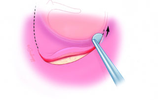 The incision is carried inferiorly. As the stapes exposure is in the superior quadrant, the inferior portion of the flap can be kept quite short.