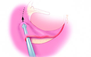 Using either a stapes knife or annulus elevator, a tunnel is created under the so-called vascular strip, the portion of the flap most likely to bleed.