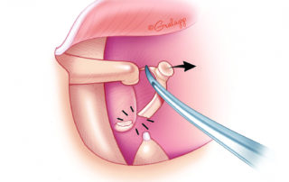 Removal of the stapes superstructure through down fracture toward the promontory. This maneuver should always be conducted away from the facial nerve. The curved needle (e.g., Rosen) should contact both crura, but preferentially apply force to the anterior crus. Excessive pressure on the posterior crus will potentially lead to transverse footplate fracture. Note that this maneuver has to be done briskly. A slowly building motion may mobilize the footplate, while a quick snapping motion will have the desired effect of fracturing the bases for both crural arches as desired. After removing the stapes superstructure, it is important to recheck that the footplate remains intact and fixed. Niche bleeding can be controlled by placing a small pledget of epinephrine-soaked absorbable gelatin sponge in the niche for a minute or two.
