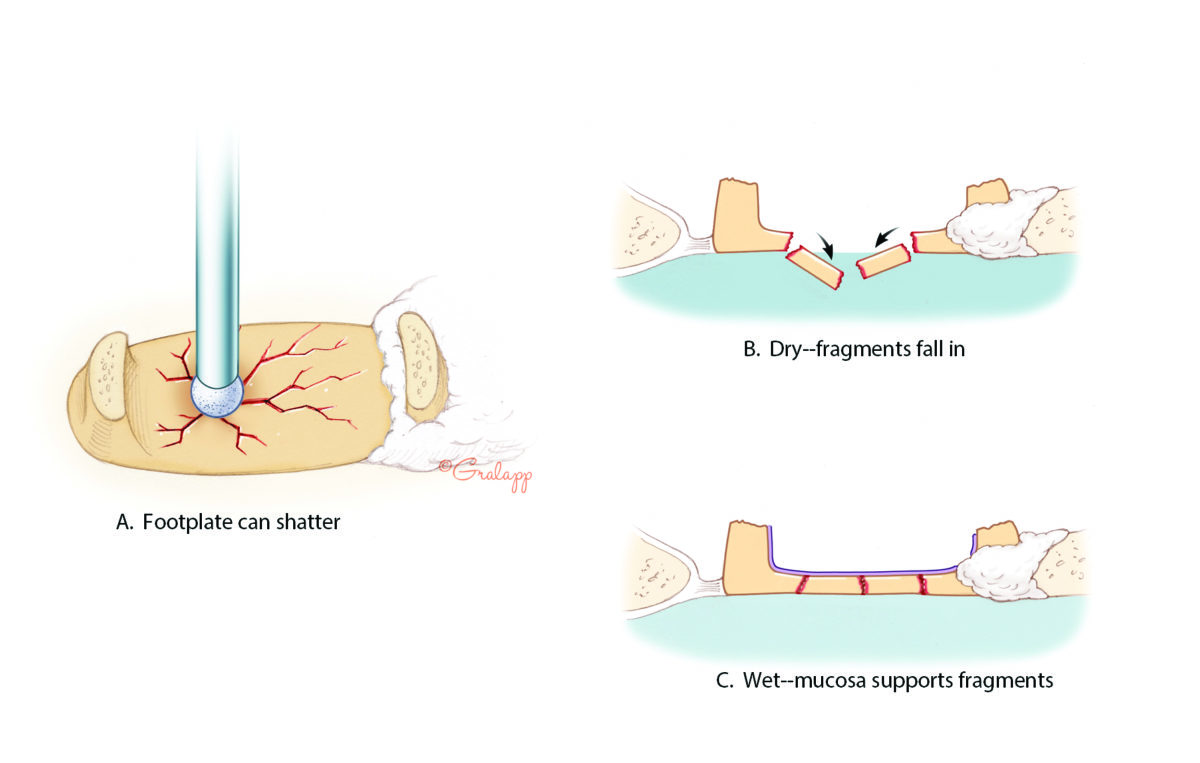 Stapedotomy – Oto Surgery Atlas