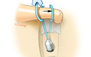 In preparation for crimping, a notched chisel (also known as strut guide) is used to move the prosthesis into position.