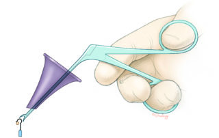 Crimping of the prosthesis on the long process of the incus is a delicate maneuver. The crimper must be stabilized on the wall of the speculum.