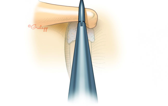 Stapedotomy – Oto Surgery Atlas