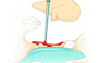 Blood is suctioned from the footplate by vacuuming anterior or posterior to the fenestra.