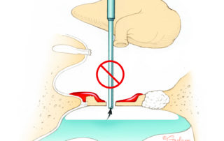 Suctioning directly over the fenestra can remove perilymph leading to a dry vestibule. This may result in sensory loss and postoperative vertigo. When air is in the vestibule, some surgeons refill it with saline, but perilymph typically replenishes spontaneously via the cochlear aqueduct. Injury to the utricle or saccule, admixing endolymph with perilymph, is a much more serious injury.