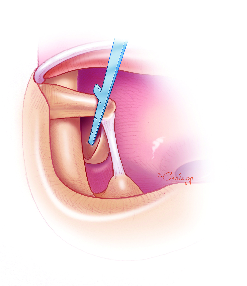 Stapedectomy: Definition, Surgery, Procedure & Recovery