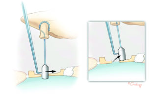 While a well-placed prosthesis will retain under gentle pressure (left), a shallowly placed prosthesis will pop out when subjected to stress (right). If this occurs, the prosthesis is replaced with another 0.25 mm longer.