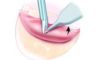 To seal a slightly too large fenestra, a pinch of connective tissue can be harvested from the flap superiorly (vascular strip).
