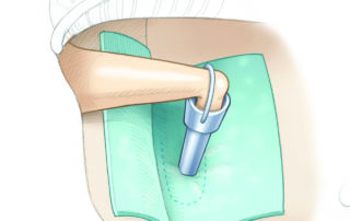 A bucket handle prosthesis requires no crimping, and the loop is simply pulled over the incus. A tissue membrane is shown sealing a large fenestra.