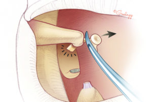 In most cases, it is difficult to target the anterior crus with the laser; so, it is snapped off mechanically.