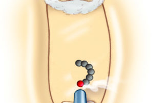 Small fenestra stapedotomy with a laser is usually created with a rosette of overlapping pulses. As the unpigmented footplate may act like a laser mirror, the process may require initiation by allowing a drop of blood to form on the footplate. To catalyze energy absorption, each successive laser shot overlaps the char from the last one slightly.