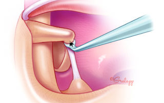 The joint is cut with a gentle “worming” motion in the anterior direction. During this maneuver, gentle outward lifting of the incus is best while strictly avoiding a downward pressure on the stapes capitulum.