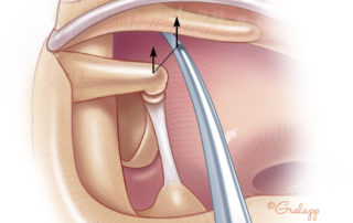 After cutting the incudostapedial joint, mobility of the lateral ossicular chain is tested by pushing gently outward on the malleus. In about 1 of 200 stapes explorations, the lateral ossicular chain will prove to be fixed.