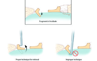 When a footplate fragment begins to fall into the oval window, it is a central axiom of stapes surgery not to reach into the vestibule. Often the fragment can be retrieved by engaging the crural base remnant with a hook.