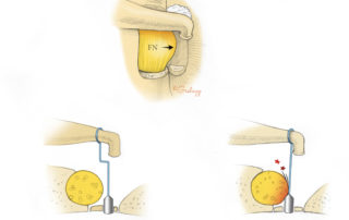 While a severely protruding facial nerve renders stapes surgery impossible, minor degrees of prolapse can be accommodated by routing the wire around the nerve using the double bend technique.