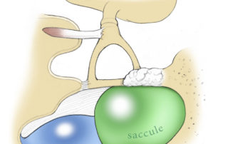In endolymphatic hydrops (e.g., Meniere’s disease), the saccule may swell against the undersurface of the footplate. For this reason, hydropic symptoms contraindicate stapes surgery. Hydrops and otosclerosis may coexist, as depicted here, perhaps due to otosclerotic involvement of the vestibular aqueduct.