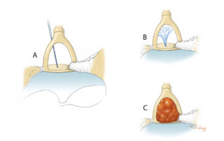 In rare instances, the inner ear may have CSF pressure within it. This may occur in certain inner ear malformations (e.g., large vestibular aqueduct) as well as the X-lined gusher syndrome. In congenital conductive hearing loss, a CT scan should be obtained to rule out inner ear malformation. Stapes surgery is contraindicated in inner ear malformation as the audiogram may reflect a pseudoconductive hearing loss and the risk of hearing loss is high. In conductive loss existing since early in life (whether in a child or adult), creation of a control hole (a) may help detect a gusher. Should a gusher occur (b), a soft-tissue plug can be placed beneath the stapes arch (c).