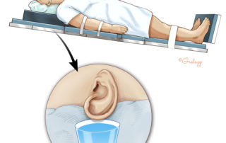 When the drainage has ceased, the head is elevated into reverse Trendelenburg. The surgeon can then complete the soft-tissue closure of the oval window in a dry field. A lumbar subarachnoid drain may be placed.