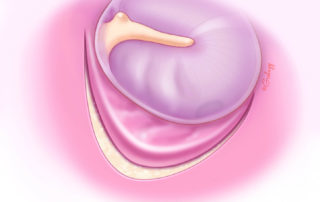 The edge of the tympanomeatal flap is curled under.