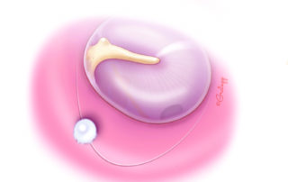 Infolding of the tympanomeatal flap edge can lead to formation of a keratin pearl.