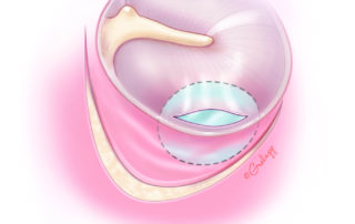 As the incision has devascularized the posterior aspect of the tympanic membrane, spontaneous healing is not assured. The tympanic membrane is best repaired with a perichondrial or fascial graft placed medial to the tear.