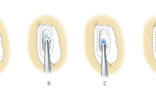 Managing obliterative otosclerosis is quite straightforward. Using a cutting burr (e.g., 0.8 mm), the footplate is thinned until a blue region has been created. A routine small fenestra opening may then be formed with a diamond burr through the thin area.