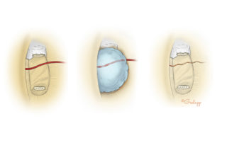 Placing an epinephrine (1:1,000) soaked absorbable gelatin sponge pledget can help shrink the stapes artery remnant. The fenestra can usually be placed posterior to the vestigial artery without disturbing it.