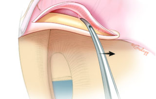 A pocket is raised from the malleus short process to the umbo to accommodate the prosthesis, exercising care to avoid tympanic membrane disruption.