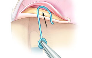 Technique of inserting an incus replacement wire (Sheehy IRP).