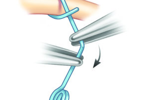 To avoid the need for various lengths, a long prosthesis is used which is bent before positioning above the oval window.