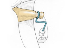 A longer prosthesis using a double-bend technique restores continuity. A malleus to footplate prosthesis is an alternative solution.
