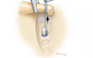 Removing a stapes prosthesis during revision surgery requires a two-handed maneuver with stabilization of the incus (shown here with a notched chisel also known as a strut guide). A hook is used to pry the prosthesis from the stabilized incus.