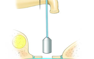 Displacement of the prosthesis due to loosening of the crimp from the incus. A fully slipped crimp will cause major conductive hearing loss while loose crimp may be associated with variable conductive hearing loss that comes and goes as middle ear pressure varies.