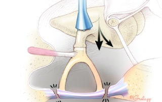In stapes mobilization, an elephant’s foot (the “Derlacki mobilizer”) is used to rock the superstructure. Mobilization should always be attempted during surgery for congenital stapes fixation, but is not often successful due to lack of an annular ligament. Should mobilization be achieved, there is no need to proceed with stapedotomy as, in the absence of active bone disease such as otosclerosis, the stapes will not refix.