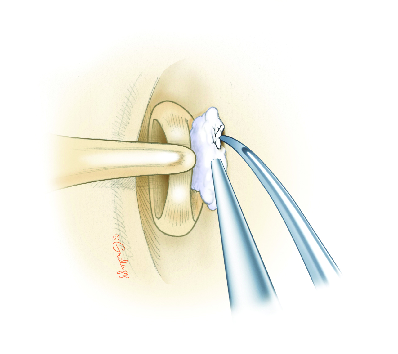 Tympanosclerosis – Oto Surgery Atlas