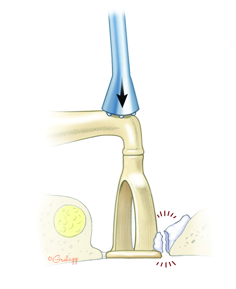 Tympanosclerosis – Oto Surgery Atlas